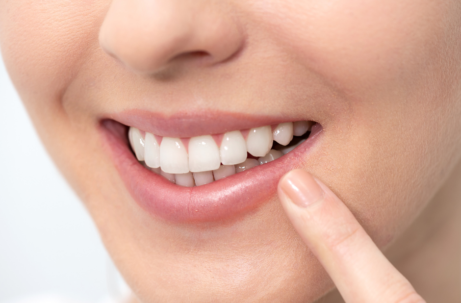 Blanqueamiento dental: qué es, tipos y resultados